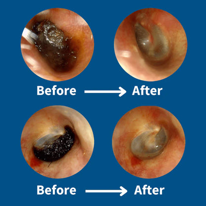 2026  Hot Sale 49% OFF🔥Earwax Removal Kit
